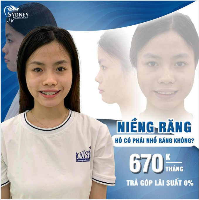 CÓ PHẢI NHỔ RĂNG KHI NIỀNG RĂNG HÔ KHÔNG?