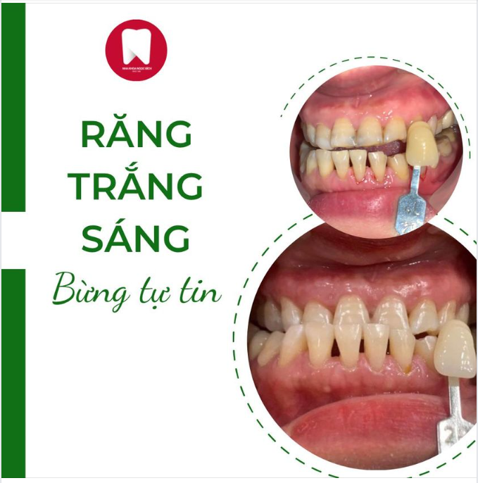 CÓ NÊN TẨY TRẮNG RĂNG HAY KHÔNG?