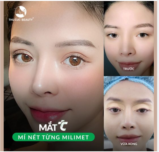 MẮt TC đẹp từng milimet