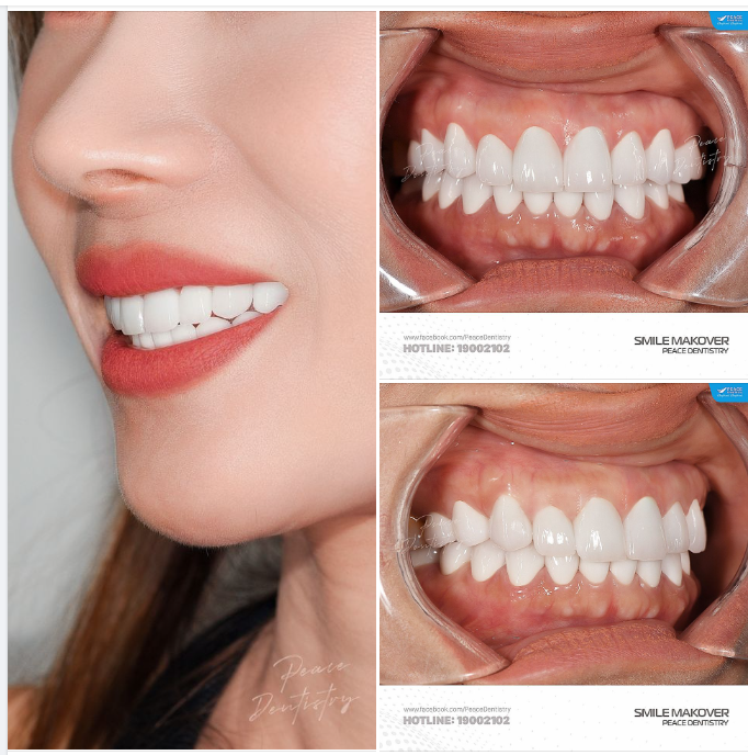 Ca lâm sàng thẩm mỹ răng sứ & cấy ghép implant để thiết kế lại nụ cười cho nữ doanh nhân