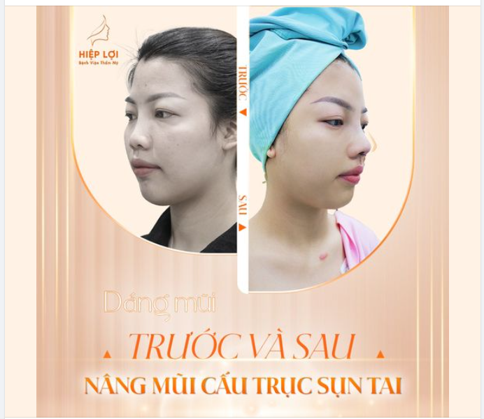 Ca nâng mũi CẤU TRÚC SỤN TAI