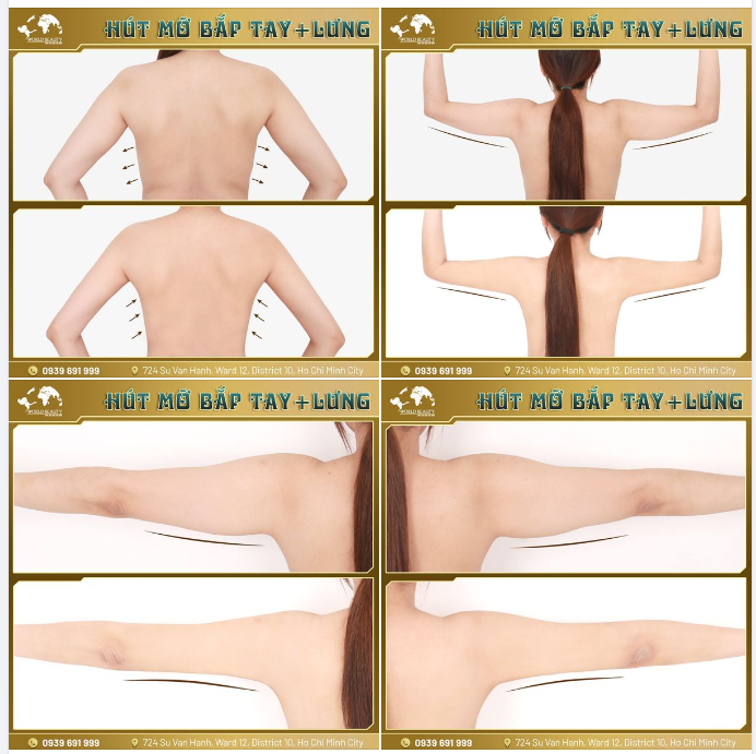 Tạo hình đường nét Body thanh mảnh, săn chắc bằng combo phẫu th.uật HÚT M.Ỡ BẮP TAY + LƯNG