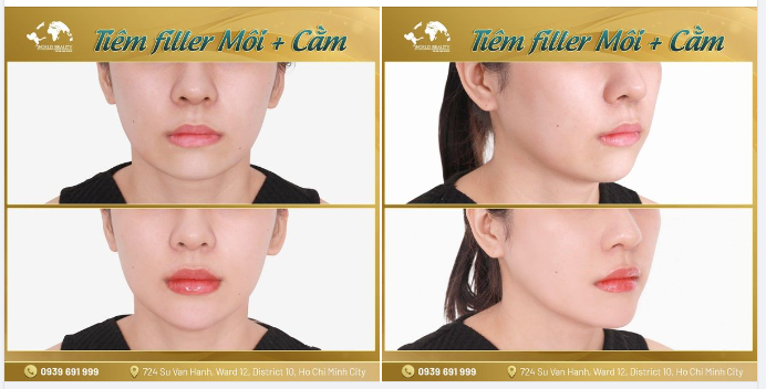 Combo TẠO HÌNH MÔI + CẰM cân chỉnh hài hòa ngũ quan cho tổng thể khuôn mặt