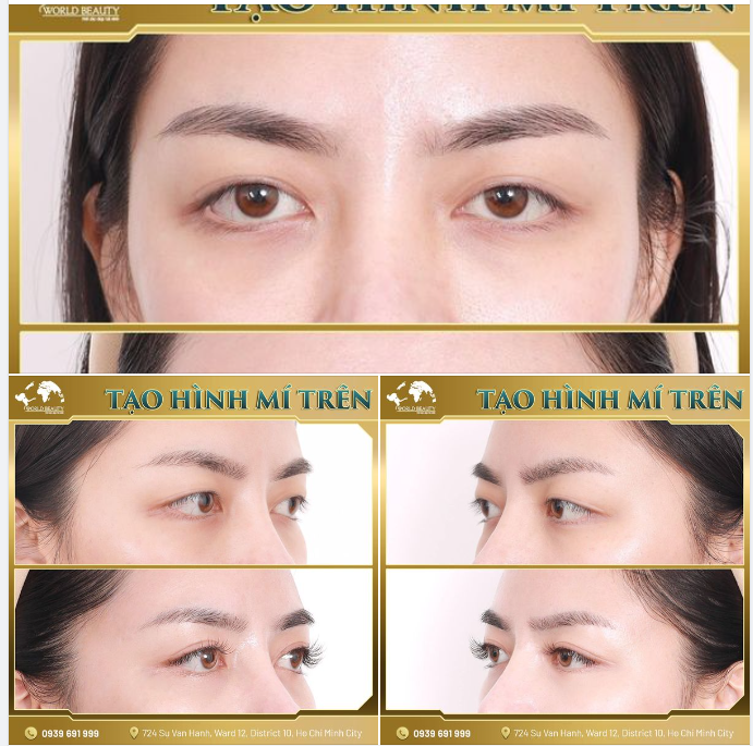 MẮT PHƯỢNG MÀY NGÀI - Tâm điểm của sự thu hút trên gương mặt cho quý Chị em chỉ với ph.ẫu th.uật Tạo hình mí trên