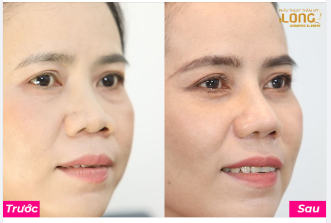 NÂNG MŨI CÓ ƯU ĐÃI KHÔNG? NÂNG MŨI GIÁ BAO NHIÊU?