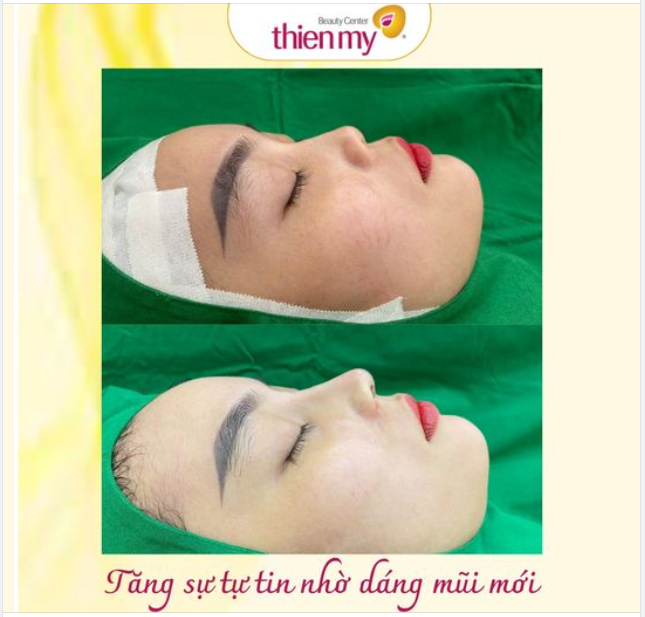 Nâng mũi cấu trúc là kĩ thuật đỉnh cao của nâng mũi hiện đại và an toàn theo cách toàn diện.