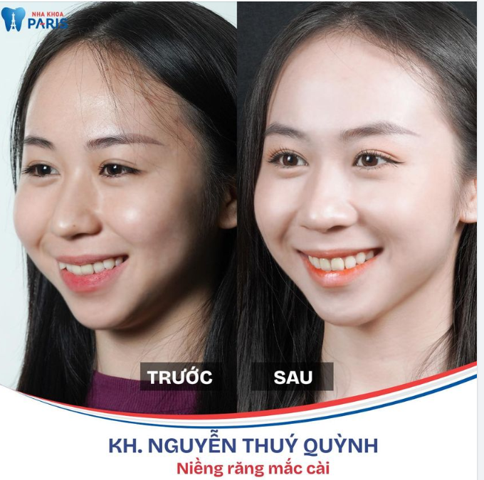 RĂNG KHỂNH CŨNG XINH NHƯNG RĂNG ĐỀU THÌ VỪA XINH, RĂNG VỪA KHOẺ MẠNH!