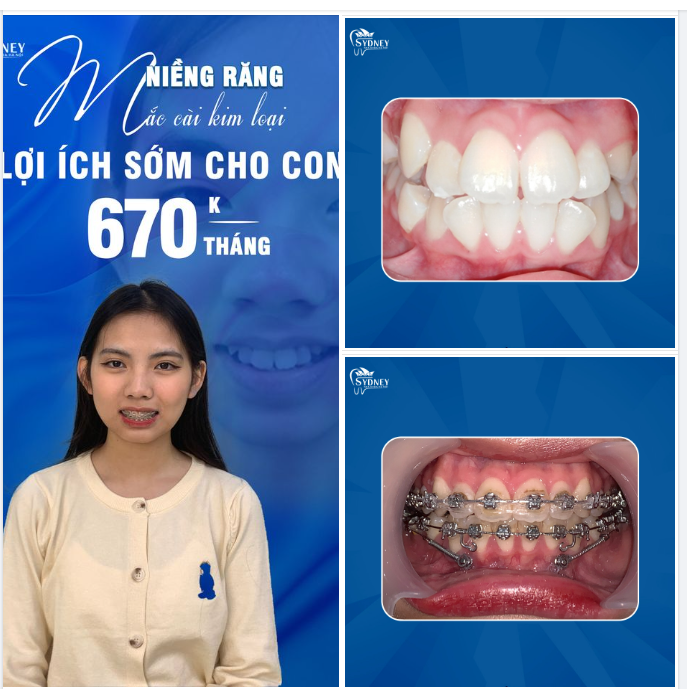 BỐ MẸ CẦN CHUẨN BỊ NHỮNG GÌ KHI NIỀNG RĂNG CHO CON?