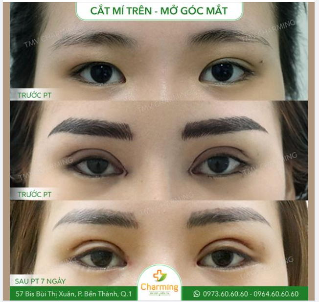 Góc mắt hẹp kéo da mí trên xuống khiến mắt hai mí mà như thể một mí. Mà một mí, bên hai mí nữa mới kì cục cơ chứ