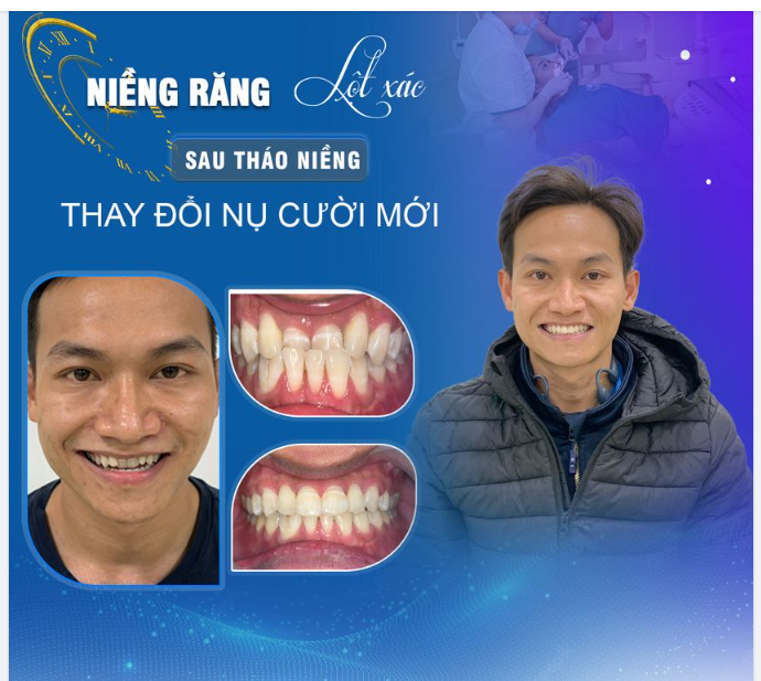 NOEL CẬN KỀ – NIỀNG RĂNG MANG VỀ NỤ CƯỜI CHUẨN