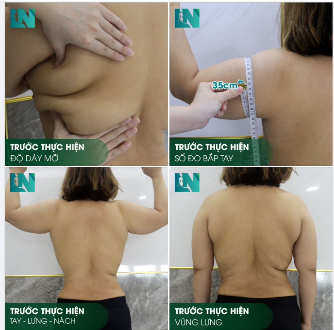 CHIA SẺ HÌNH ẢNH TRƯỚC KHI THỰC HIỆN HÚT MỠ TẠO DÁNG TAY - LƯNG - NÁCH CHO CHỊ KHÁCH HÀNG SINH NĂM 1984