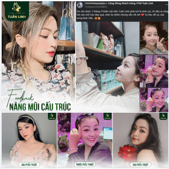 NÂNG MŨI CÓ ĐẸP ĐƯỢC LÂU DÀI KHÔNG?