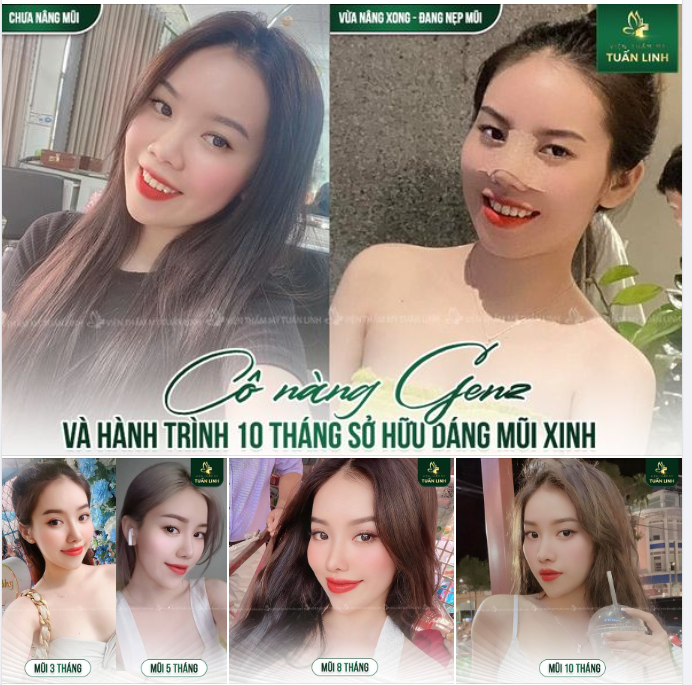 Cô nàng GenZ: Gấp đôi visual sau 10 tháng nâng mũi