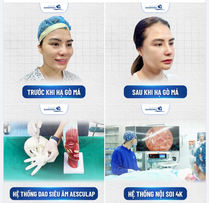 Hiện nay Bệnh viện Gangwhoo đầu tư rất nhiều vào máy móc, công nghệ phục vụ cho bác sĩ trong phẫu thuật hạ gò má.