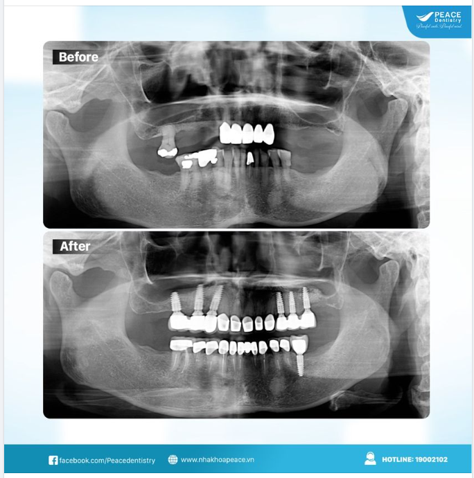 Ca lâm sàng cấy ghép 7 implant đơn lẻ với kết quả sau điều trị tuyệt vời