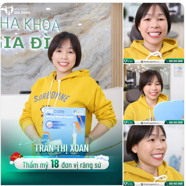 KHẮC PHỤC RĂNG THƯA - ĐÓN MƯA TÀI LỘC