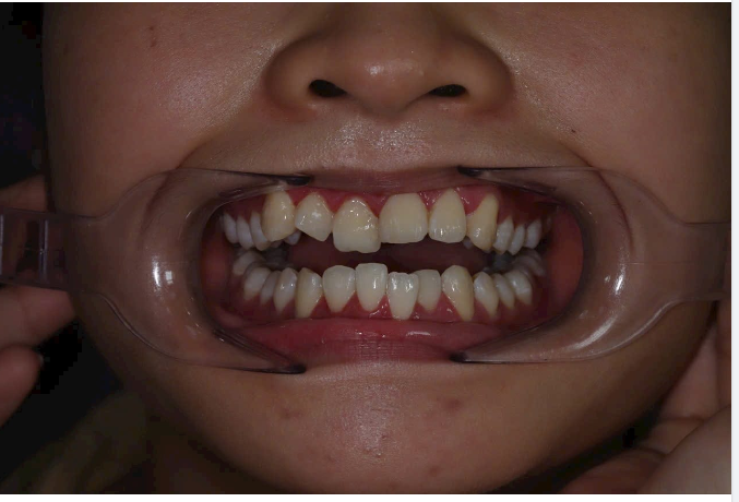 Niềng răng giải pháp tối ưu cho hàm răng lệch lạc