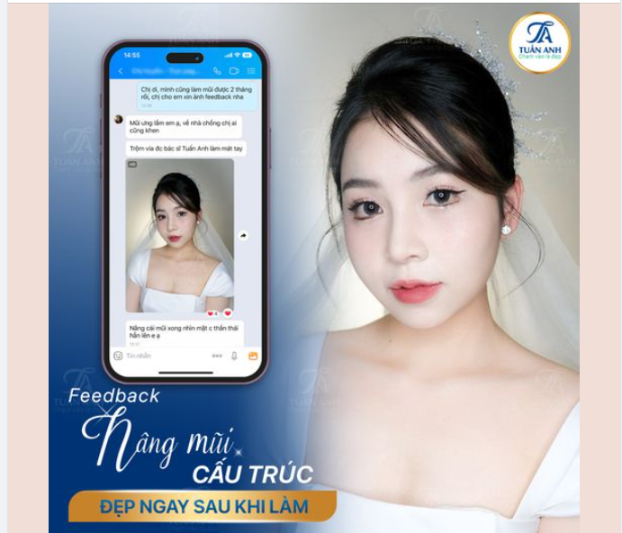 FEEDBACK SIÊU ĐÁNG YÊU ĐẾN TỪ CHỊ KHÁCH NÂNG MŨI CẤU TRÚC TẠI THẨM MỸ TUẤN ANH