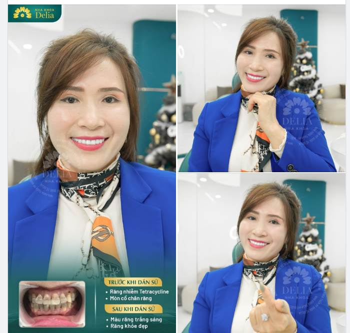 Sau khi tìm hiểu nhiều nơi, chị Nguyễn Lan quyết định đến Delia để sở hữu nụ cười khoẻ đẹp, rạng rỡ.