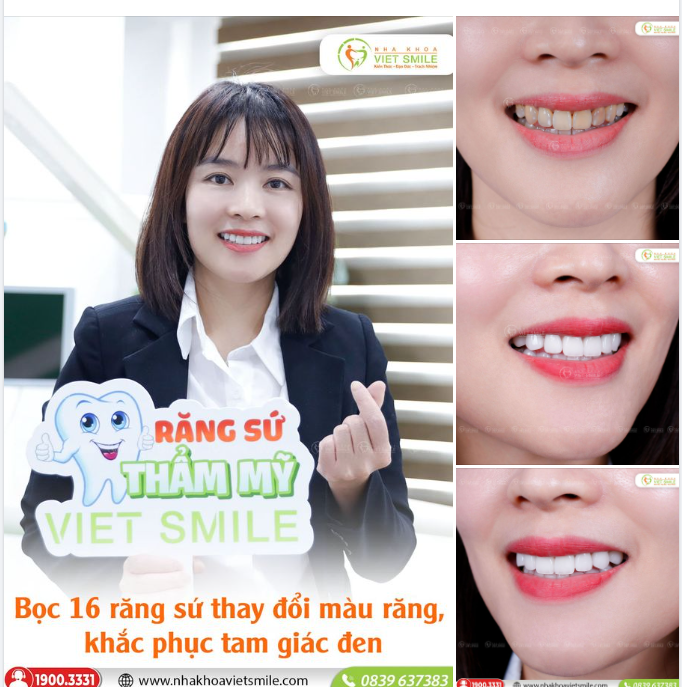 NỤ CƯỜI TRẮNG SÁNG TỰ NHIÊN SAU THẨM MỸ RĂNG SỨ