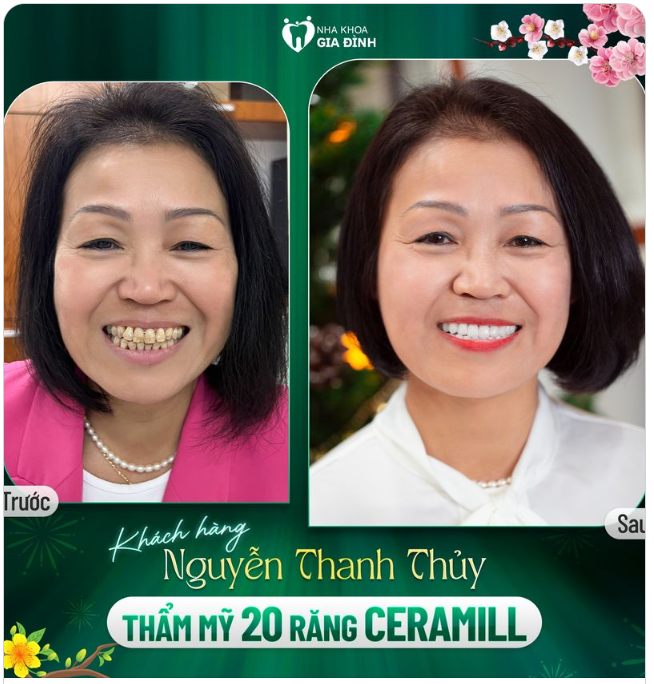 VIỆT KIỀU ĐỨC QUYẾT TÂM BAY VỀ VIỆT NAM VÀ ĐẾN VỚI NHA KHOA GIA ĐÌNH ĐỂ LÀM RĂNG THẨM MỸ
