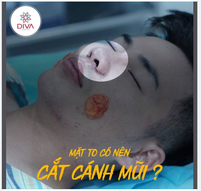 MẶT TO CÓ NÊN CẮT CÁNH MŨI ?
