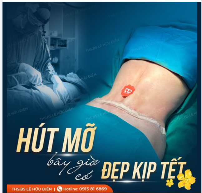 Hút mỡ bây giờ có đẹp kịp Tết không?
