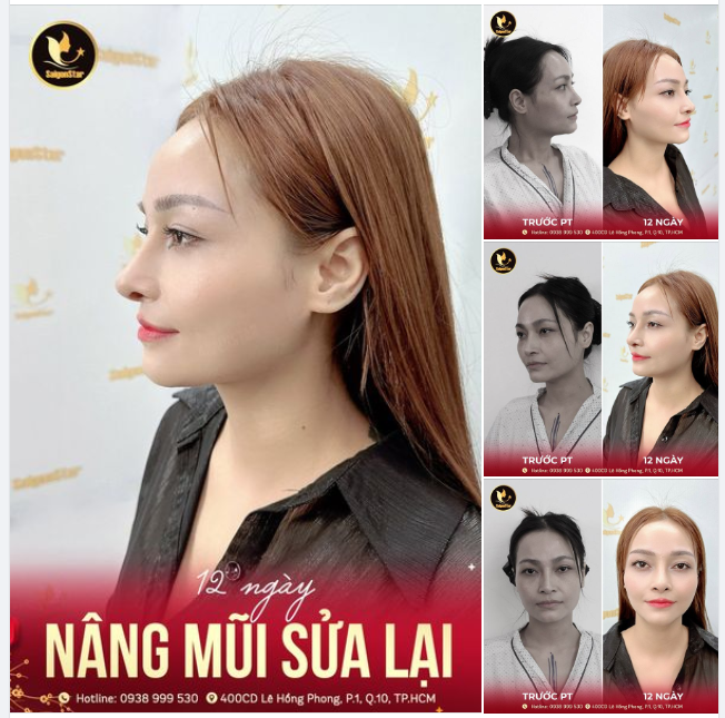 12 NGÀY NÂNG MŨI SỬA LẠI