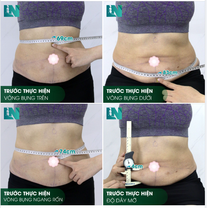 HÌNH ẢNH TRƯỚC KHI THỰC HIỆN HÚT MỠ TẠO DÁNG BỤNG - EO - HÔNG CỦA CHỊ KHÁCH SINH NĂM 1973