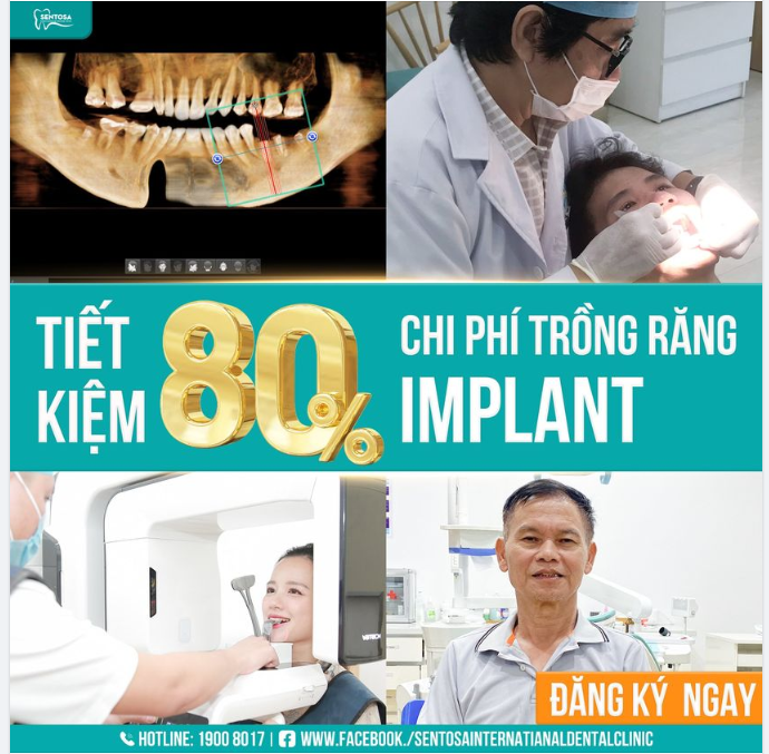 VỀ VIỆT NAM, TIẾT KIỆM 80% CHI PHÍ TRỒNG RĂNG IMPLANT