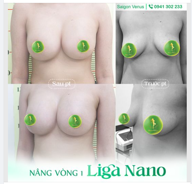 LỘT XÁC VÓC DÁNG VỚI VÒNG MỘT LIGA NANO TẠI SAIGON VENUS