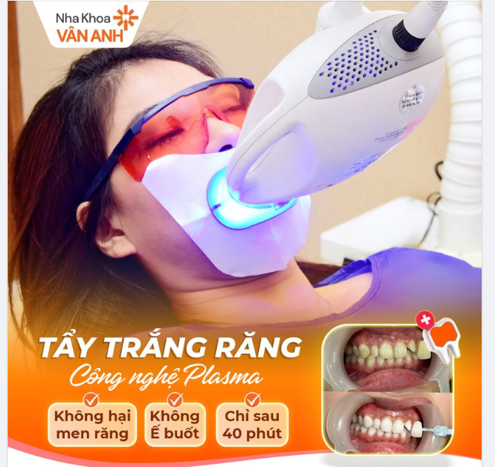 "Khám Phá Công Nghệ Tẩy Trắng Răng Plasma- Trắng Sáng Bật Tone, Không Hại Men Răng"