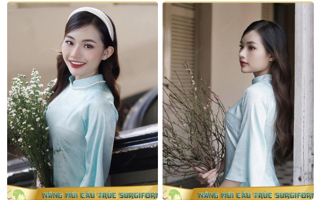 Nữ xinh 2k xinh xắn trong giao diện nàng thơ sau 1,5 nâng cấp mũi bằng sụn tự thân và thanh surgiform tại Thế Giới Đẹp