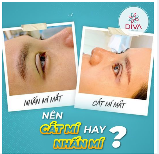 NÊN NHẤN MÍ HAY CẮT MẮT 2 MÍ ?