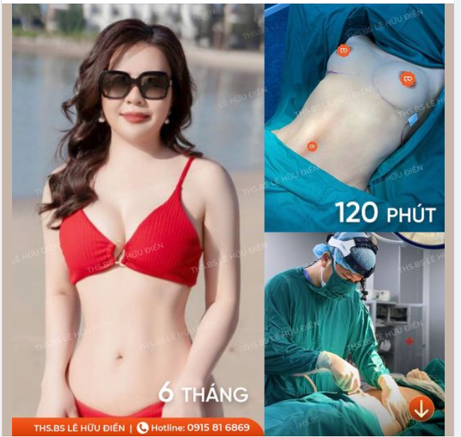 Hút mỡ nâng ngực cùng lúc được không? Bao lâu thì được bung lụa?