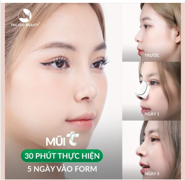 Mũi đẹp nhân đôi sau 30 phút
