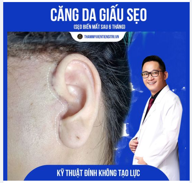 SỞ HỮU LÀN DA KHÔNG TUỔI Đặc biệt : CĂNG DA GIẤU SẸO TẠI DR.TRÍ