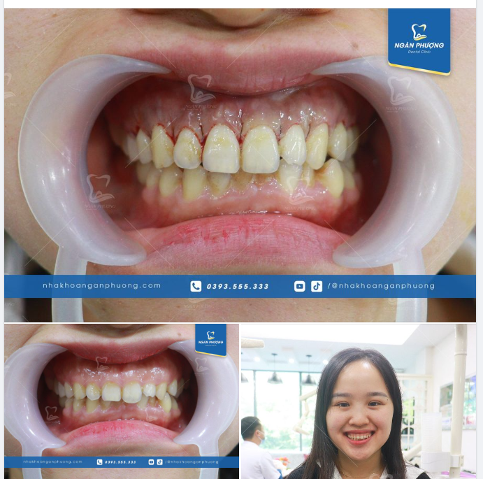 Hẹn bạn Trinh Tuyết cuối tuần này cắt chỉ để tạm biệt cười hở lợi nhé