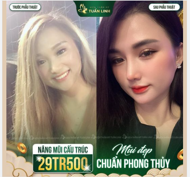 NÂNG MŨI PHONG THỦY - ĐÓN NĂM MỚI PHÚ QUÝ