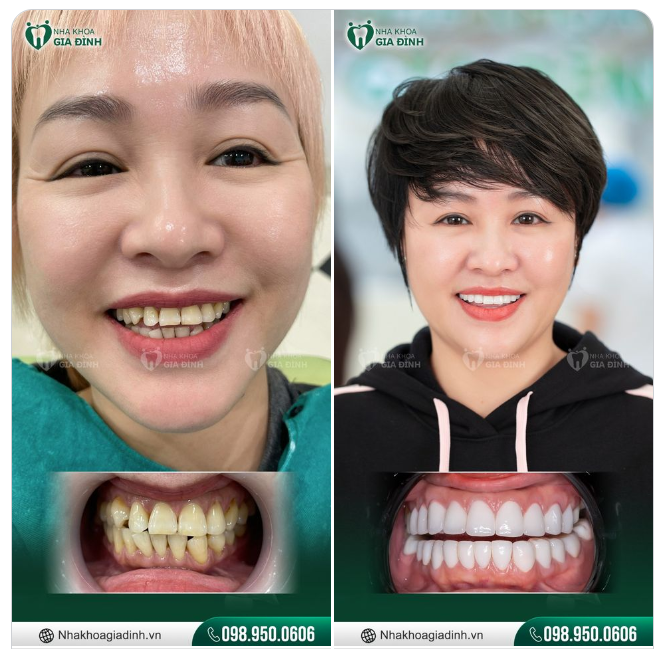 GẠT BỎ NHỮNG ƯU PHIỀN RĂNG XẤU, TÌM LẠI NÉT DUYÊN NHỜ NỤ CƯỜI MỚI