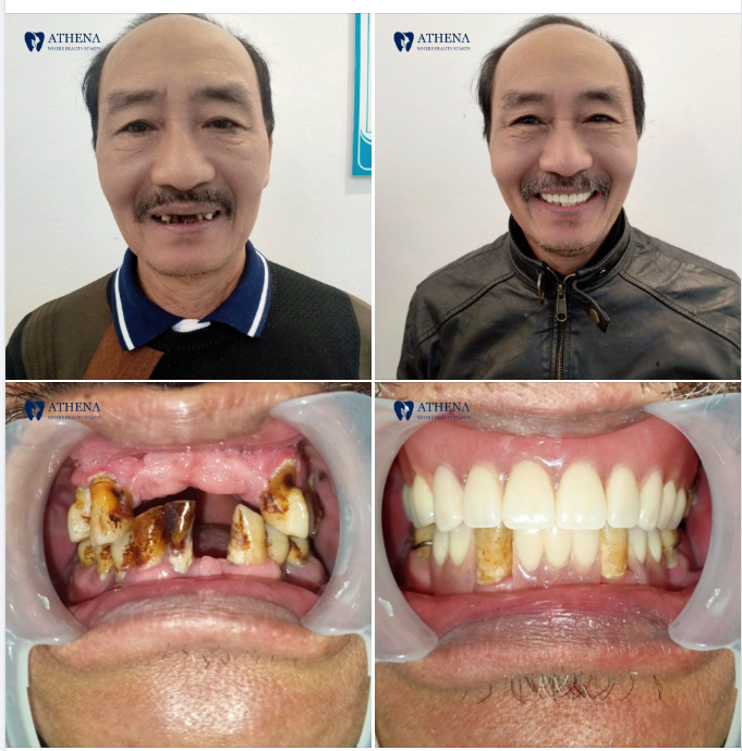LÀM RĂNG PHONG THỦY - ĐỔI VẬN PHÚ QUÝ