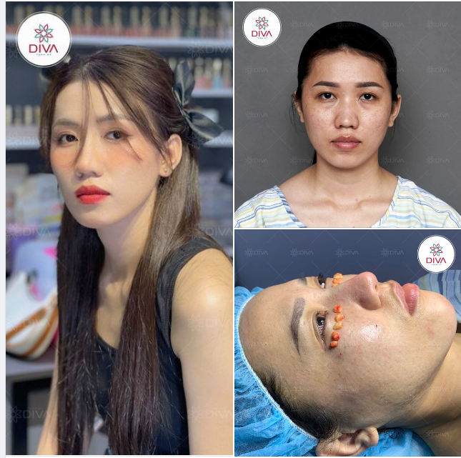 ĐẸP TỰ NHIÊN CHUẨN NÉT NÀNG THƠ SAU NÂNG MŨI, CẤY MỠ, LẤY MỠ MÍ DƯỚI
