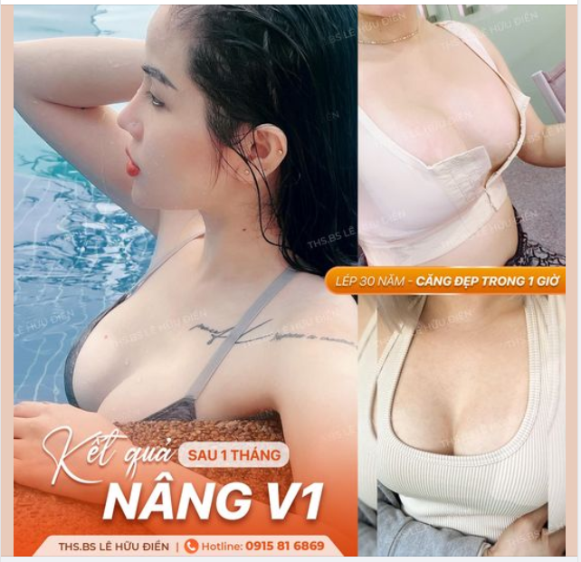 Ngực lép 30 năm - Căng đẹp trong 1 giờ