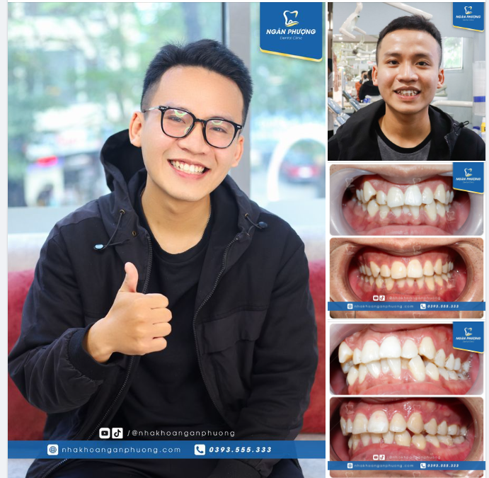 Động lực niềng răng là đây chứ đâu