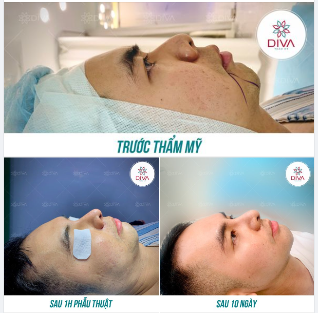 CẢI THIỆN SỐNG MŨI THẤP, CÁNH MŨI TO BÈ VỚI NÂNG MŨI TÁI CẤU TRÚC GHÉP SỤN TỰ THÂN