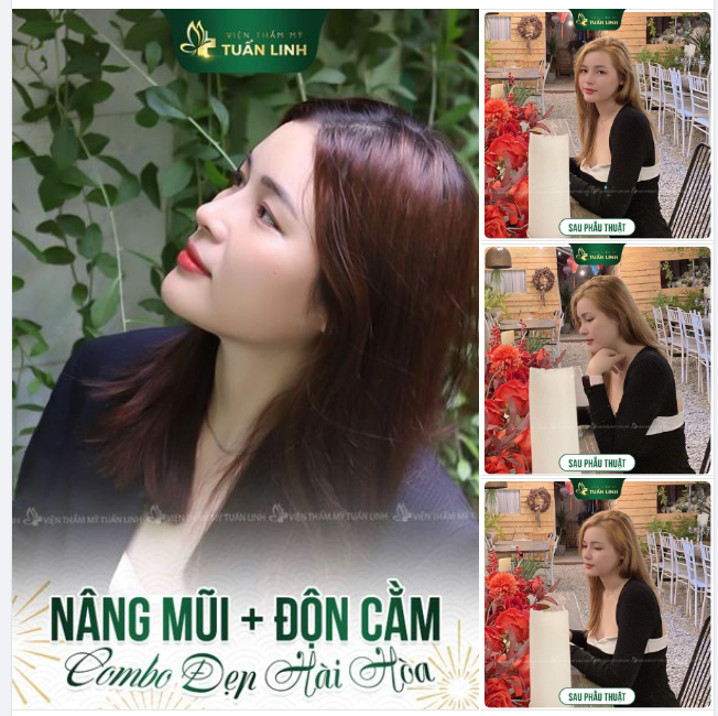NÂNG MŨI + ĐỘN CẰM  COMBO XINH ĐẸP ĐÓN TẾT!!