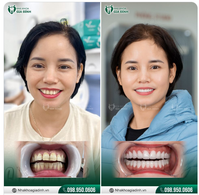 NỤ CƯỜI THÊM RẠNG RỠ NHỜ RĂNG SỨ CAO CẤP ORODENT