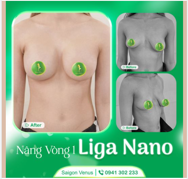 GIẢI PHÁP LIGA NANO SIÊU NHẸ NHÀNG CHO CÔ NÀNG SỢ ĐAU