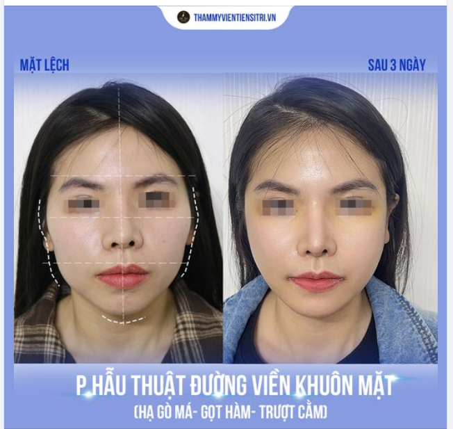 Phẫu Thuật Đường Viền Khuôn Mặt