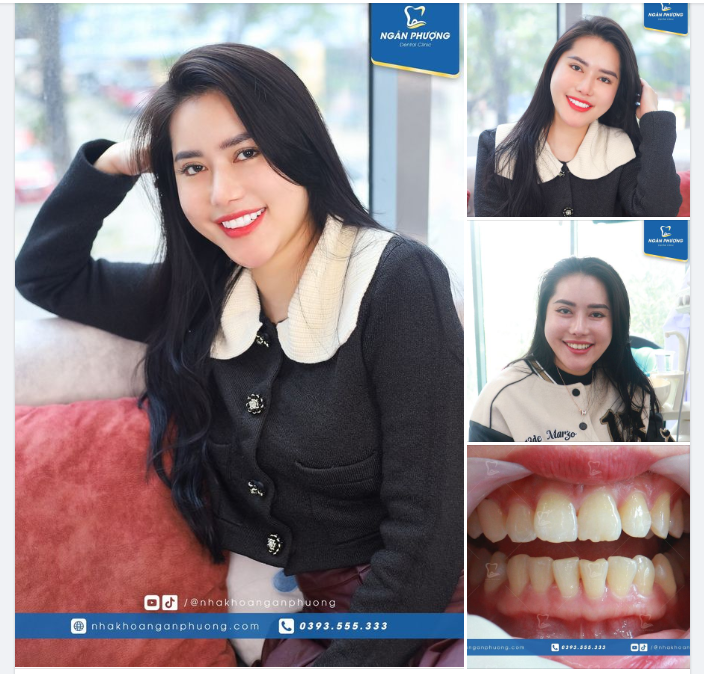 Cảm ơn chị Hà đã lựa chọn Nha khoa Ngân Phượng để thay mới nụ cười đón Tết ​​​​​​​